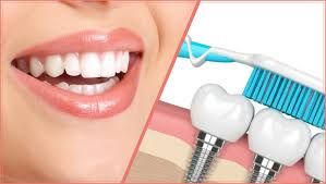 Best Cosmetic Dental Implants