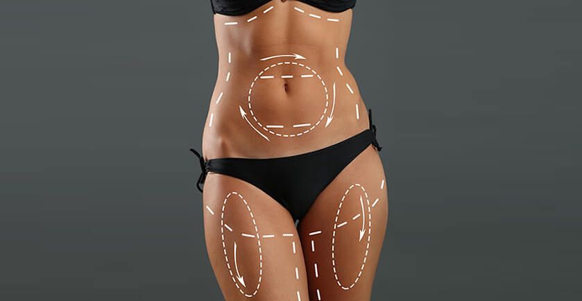 Are Liposuction Surgery Results Permanent?