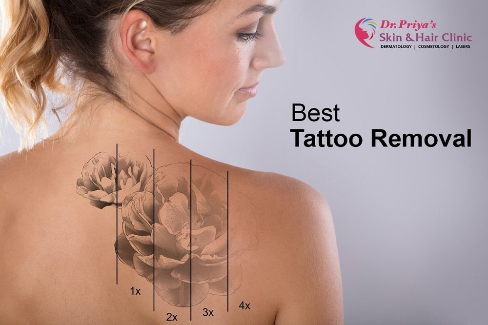 Best Laser Tattoo Removal in Bangalore - Guaranteed Results