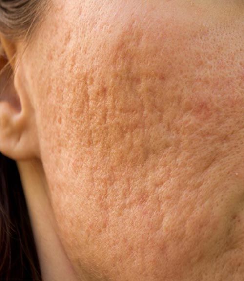 Acne Scar Reduction in Hyderabad