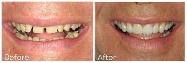 Porcelain Dental Crowns Before and After