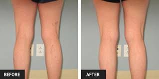 After sclerotherapy for varicose or spider veins