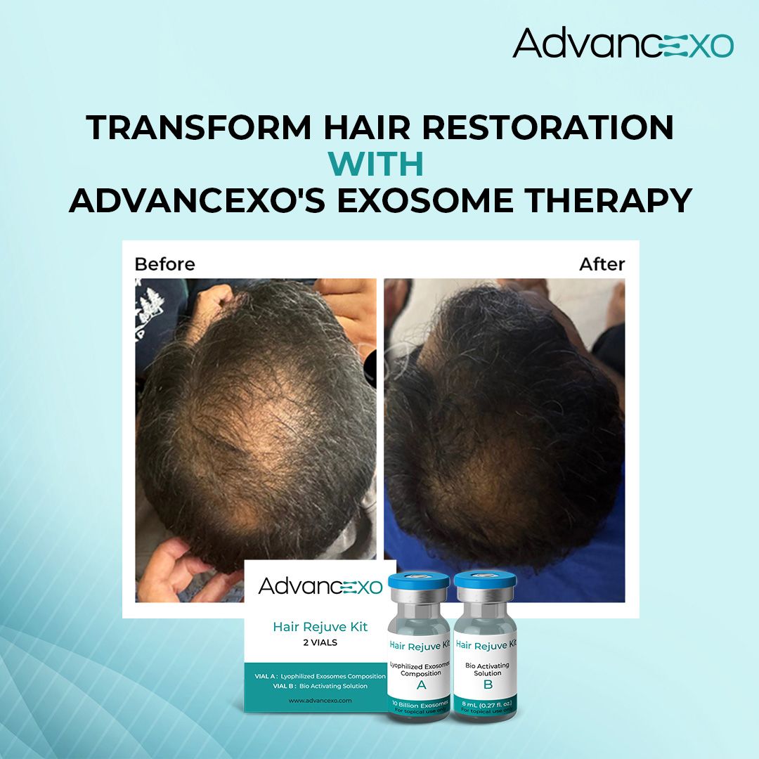 Transform Hair Restoration with Advancexo's Exosome Therapy