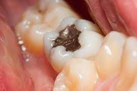 Emergency Tooth Filling Dentist Houston