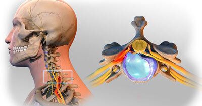 Herniated Disc in the Neck Treatment - Bronx, NY