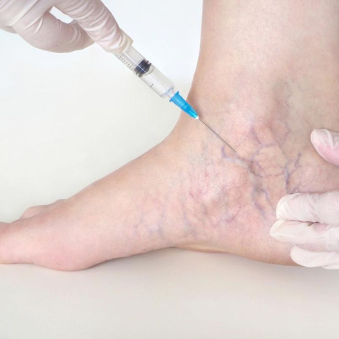 Pain-Free Solutions for Varicose Veins treatment in Maryland at Aesthetic LAVC