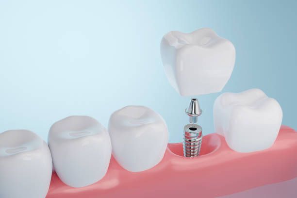Teeth Scaling & Polishing: Cost & Treatment by Hash Dental Clinic