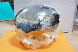 Cranioplasty  with Titanium Cranial 3D printed  Implants