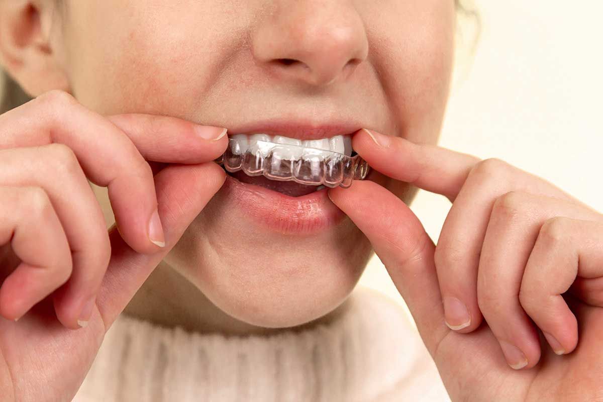 Invisalign in Leeds
