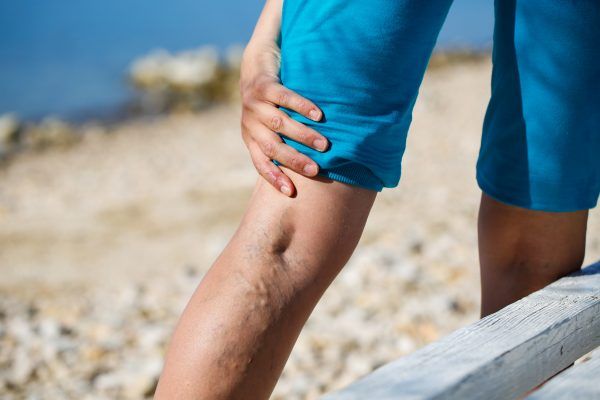 How Much Does Varicose Vein Removal Cost?