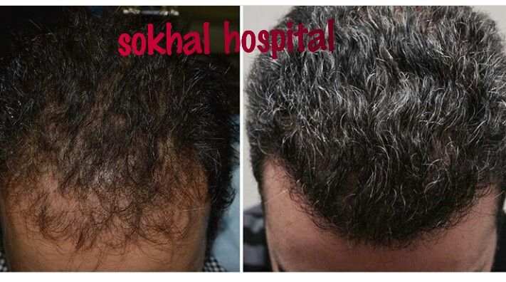 hair transplant in Jaipur