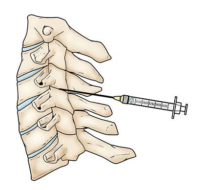 Lumbar Epidural Steroid Injection in NYC 