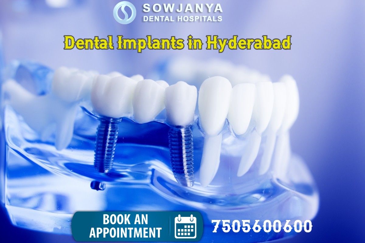 Dental Implants in Hyderabad - Best Dental Doctors in Himayat Nagar