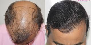 Hair Transplant in Riyadh