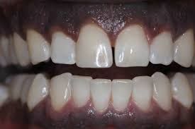 Emergency Tooth Infection Treatment in Houston