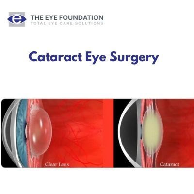 The Eye Foundation - Cataract Eye Foundation