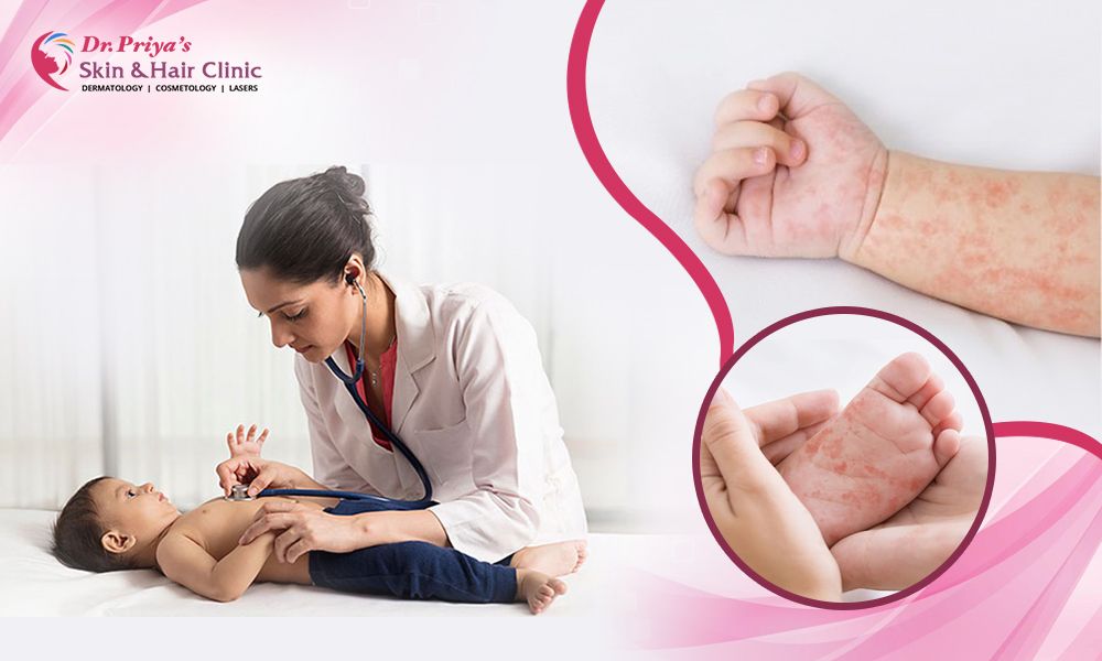 Leading Pediatric Dermatologist in Marathahalli, Bangalore - Dr. Priya Skin and Hair Clinic